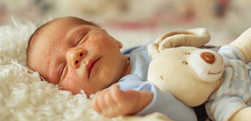 Infantile Eczema All you need to know