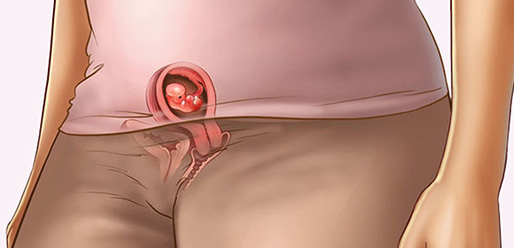 6 week Pregnant